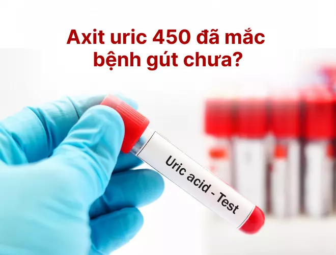Axit uric 450 đã mắc bệnh gút chưa? Làm thế nào để hạ?